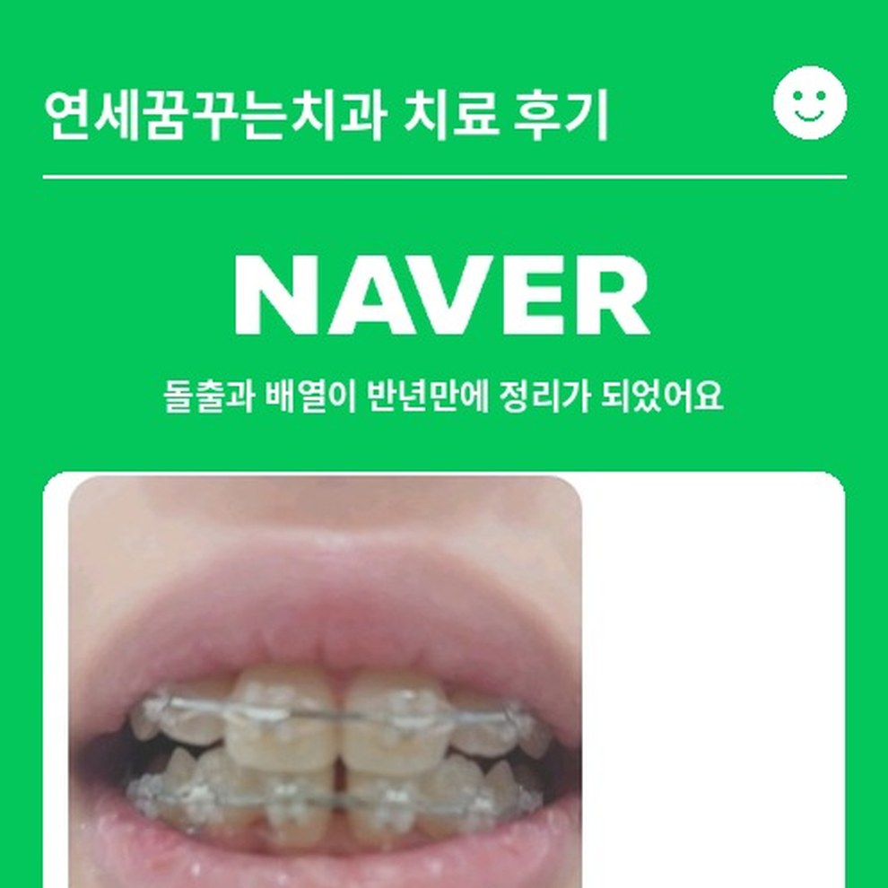 [교정] 돌출과 배열이 반년만에 정리가 되었어요｜오륜동 소아교정 후기